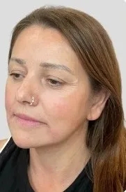After dermal filler, Example layout only. Treatment and consent to be confirmed