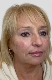 After dermal filler, Example layout only. Treatment and consent to be confirmed